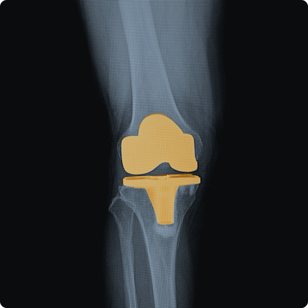 prótesis de rodilla
