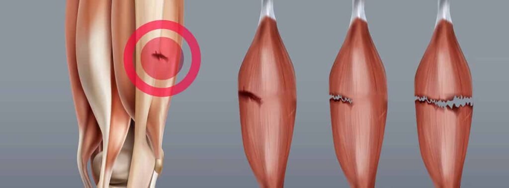 Rotura de fibras musculares en ecografía en ADH Clinic A Coruña