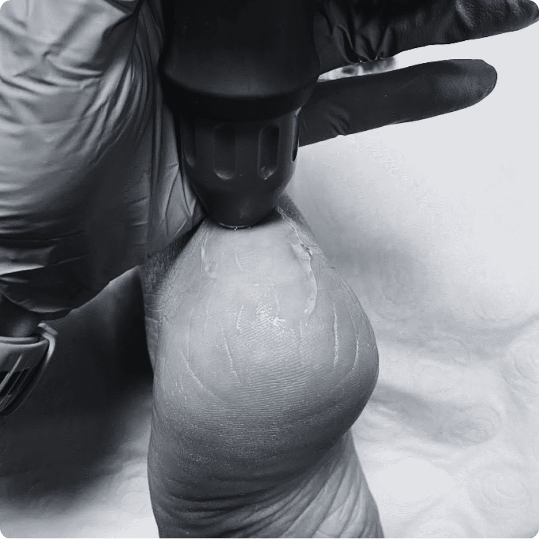 Tratamiento con tecnología avanzada