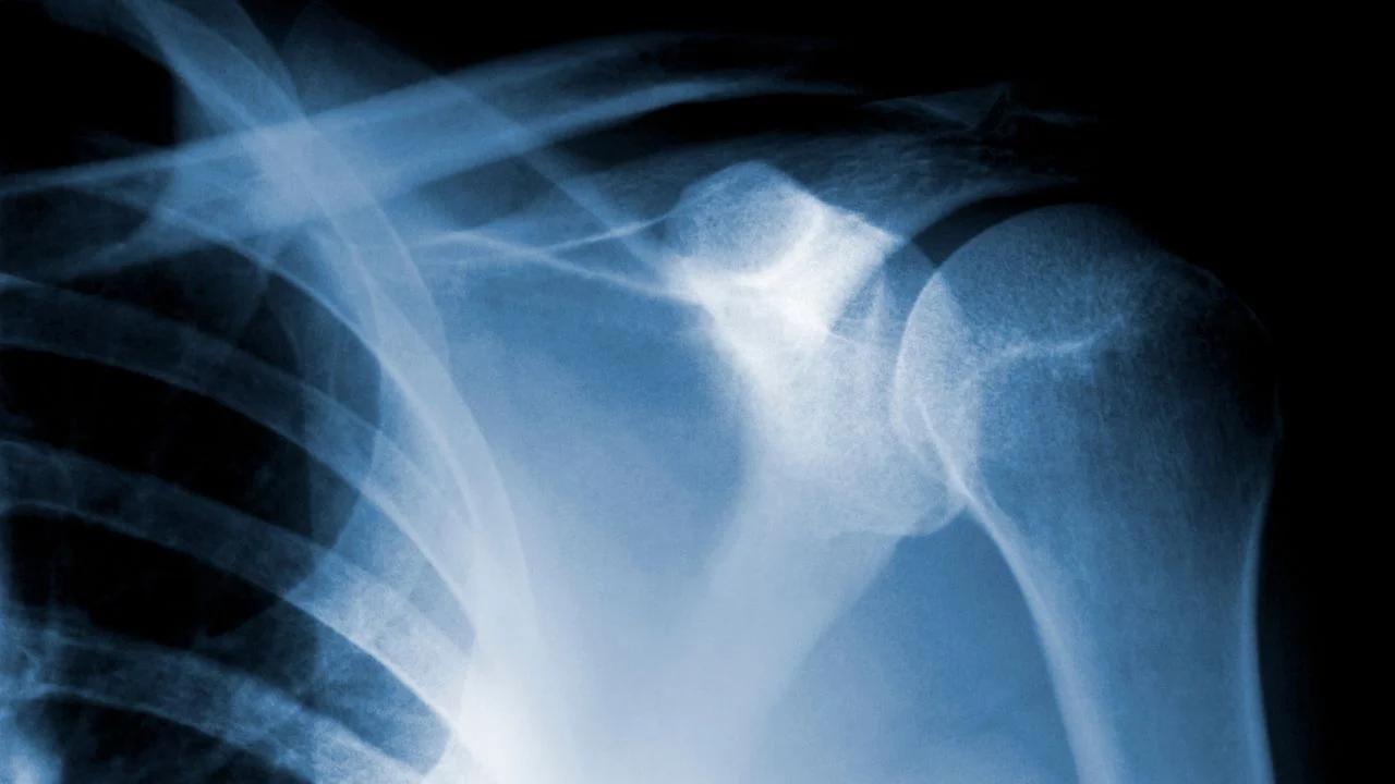 calcificaciones en fisioterapia