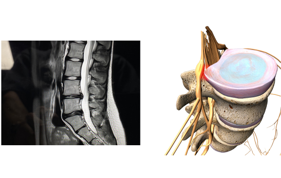 Hernia discal y dolor de columna lumbar — Unidad de Columna ADH Clínica