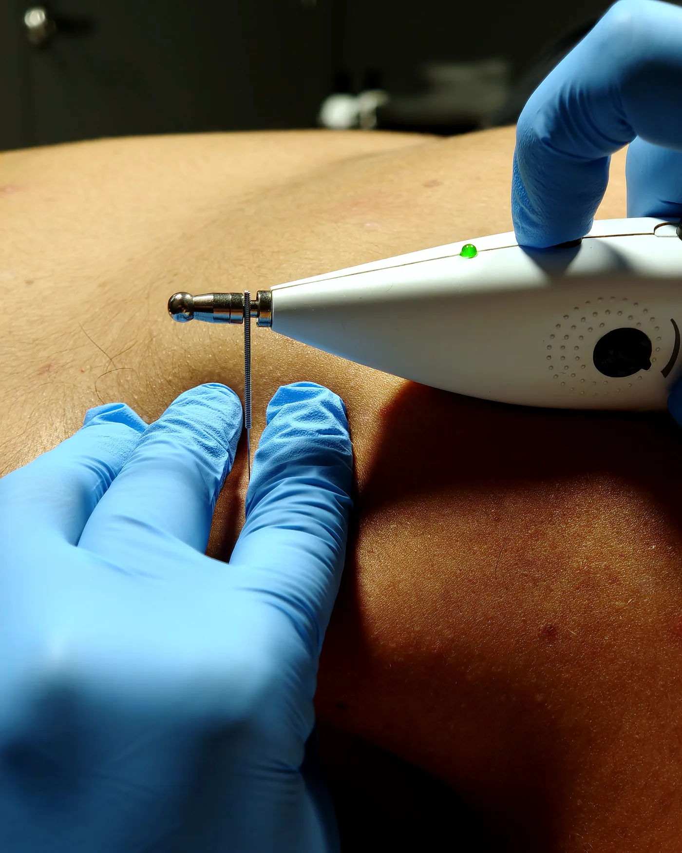 Neuromodulación percutánea ecoguiada en ADH Clinic, Oleiros