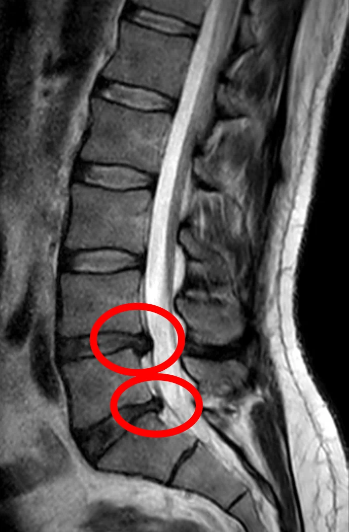 Resonancia magnética lumbar sagital con hernia discal L4-L5 y L5-S1 señaladas